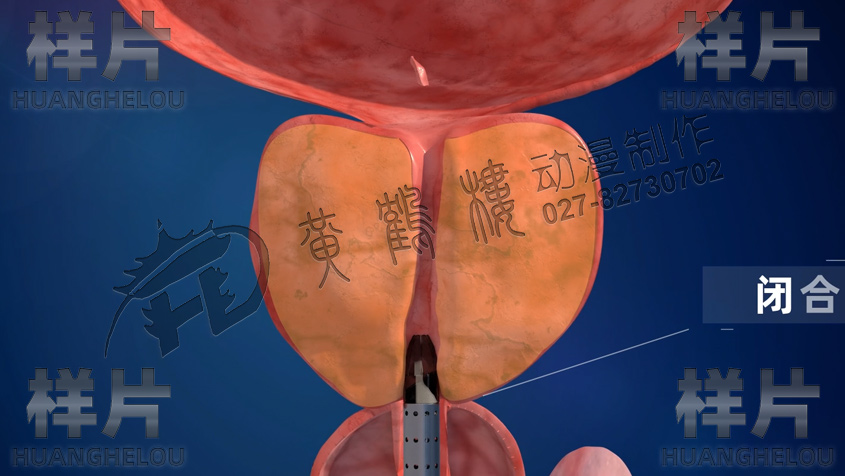 尿道保護鞘工作完閉合.jpg 尿道保護鞘工作完閉合.jpg