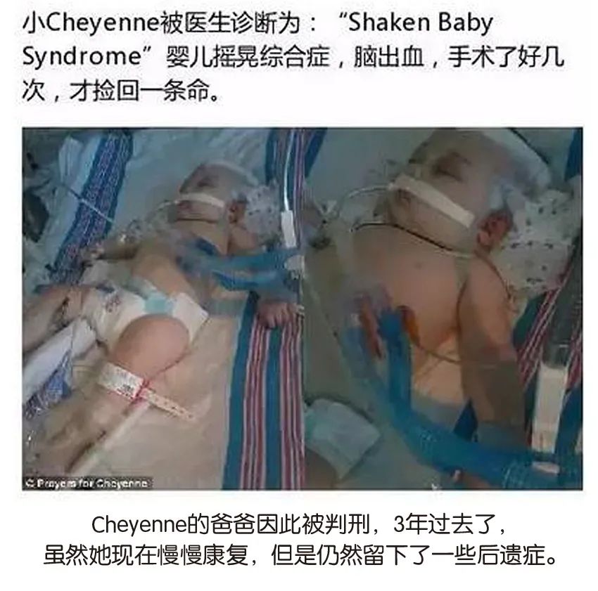 育兒醫(yī)學(xué)科普：大力搖晃會損傷寶寶的大腦致腦損傷