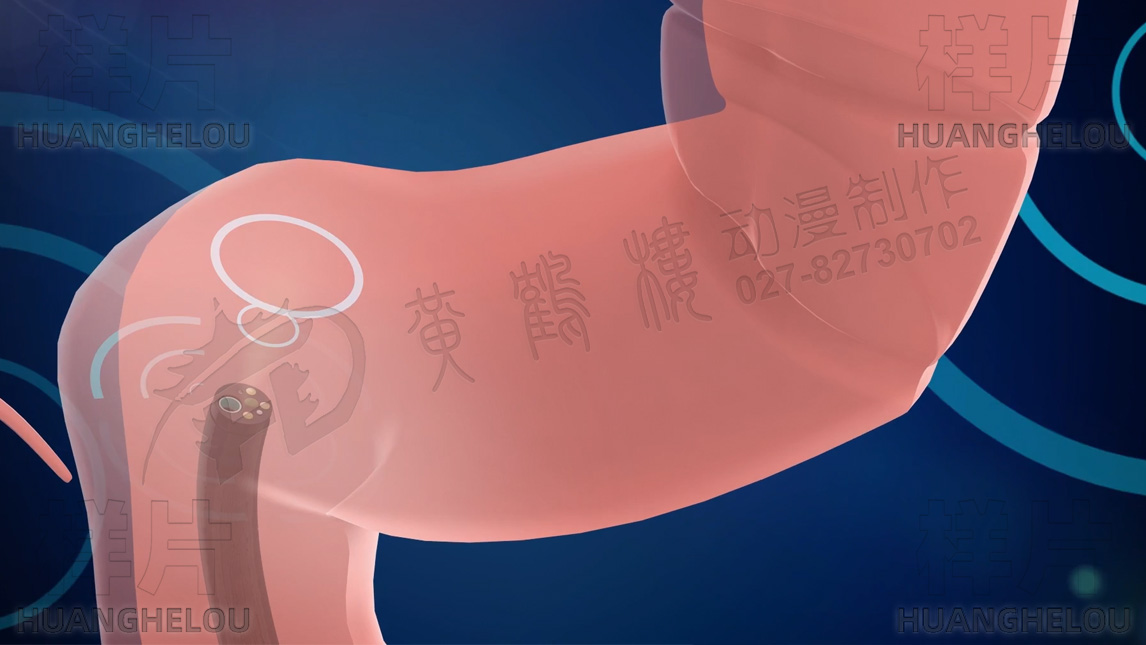 腸鏡由肛門進(jìn)入,通過(guò)鏡頭及鏡體磁圈共同作用力牽引前進(jìn).jpg 腸鏡由肛門進(jìn)入,通過(guò)鏡頭及鏡體磁圈共同作用力牽引前進(jìn).jpg